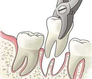 Treatment Of Painful Teeth – Extraction