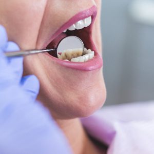 Treatment Of Sensitive Teeth.