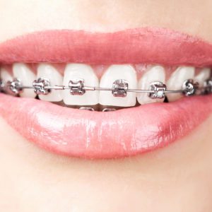 Tooth Alignment Issue Straightening Of Teeth (Braces & Aligns)