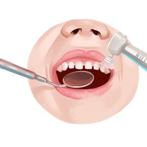 Scaling – Teeth Cleaning Procedure